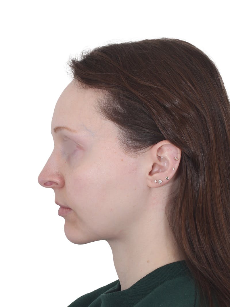 Blepharoplasty Before & After Gallery - Patient 383987 - Image 12