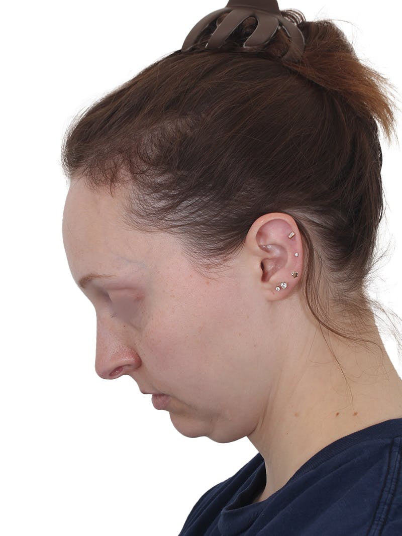 Blepharoplasty Before & After Gallery - Patient 383987 - Image 13