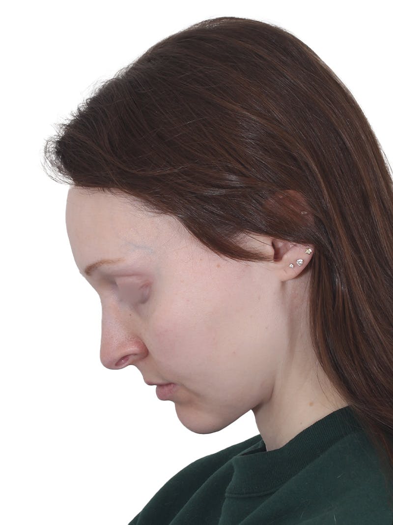 Blepharoplasty Before & After Gallery - Patient 383987 - Image 14