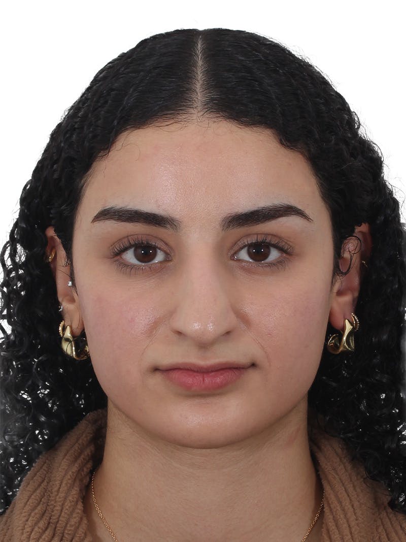 Rhinoplasty Before & After Gallery - Patient 324042 - Image 5