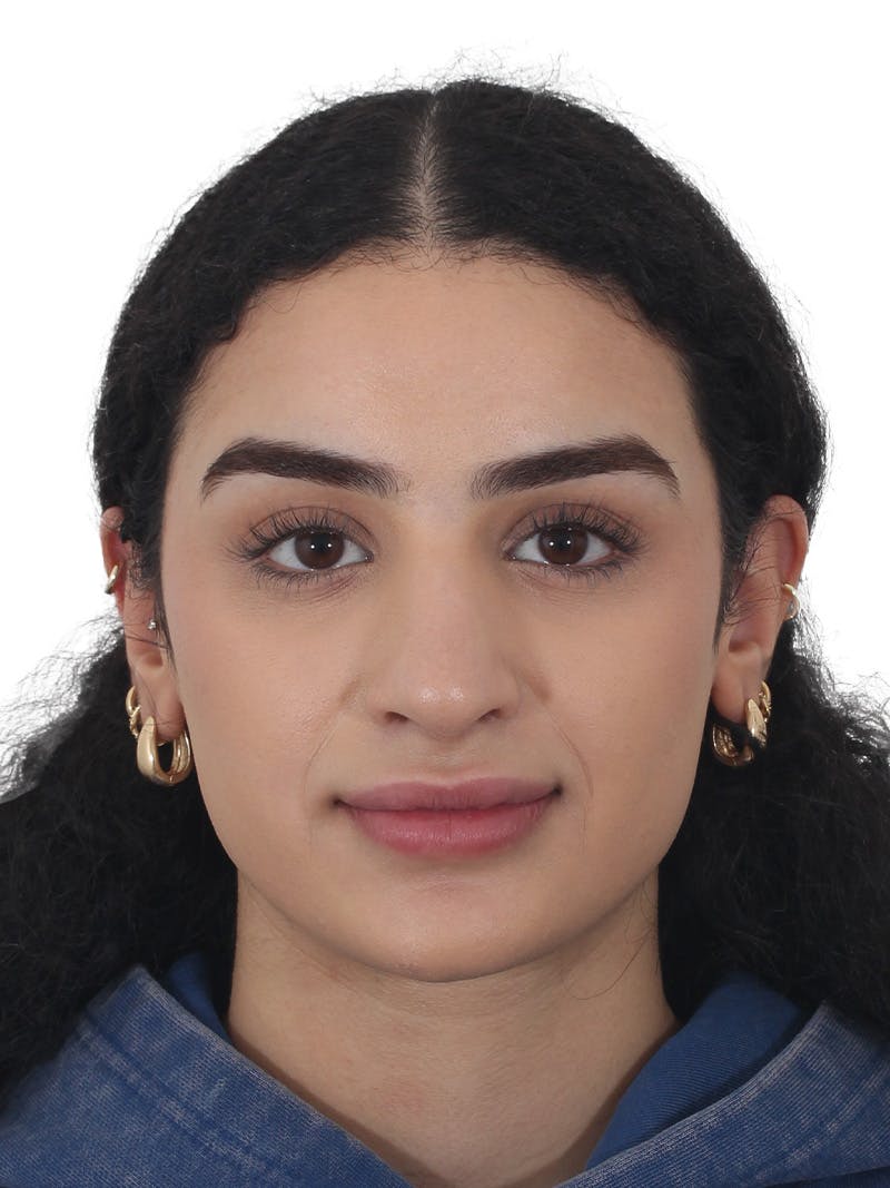 Rhinoplasty Before & After Gallery - Patient 324042 - Image 6