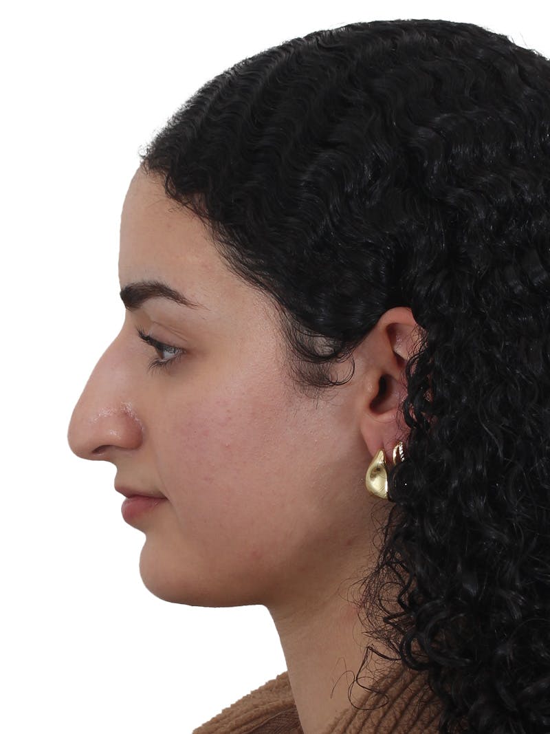 Rhinoplasty Before & After Gallery - Patient 324042 - Image 9