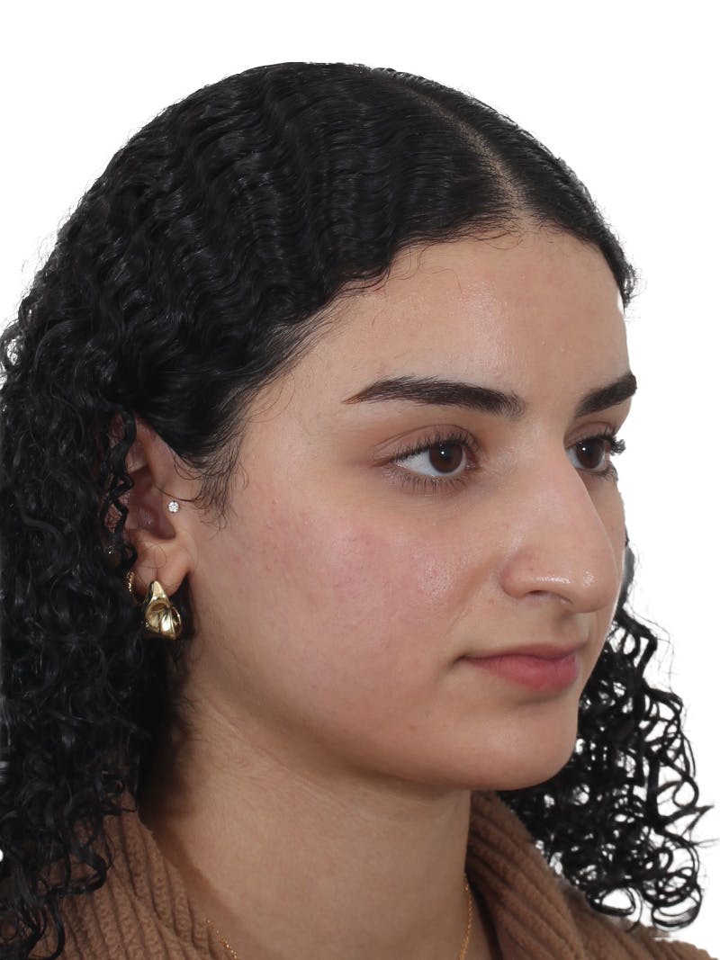 Rhinoplasty Before & After Gallery - Patient 324042 - Image 3