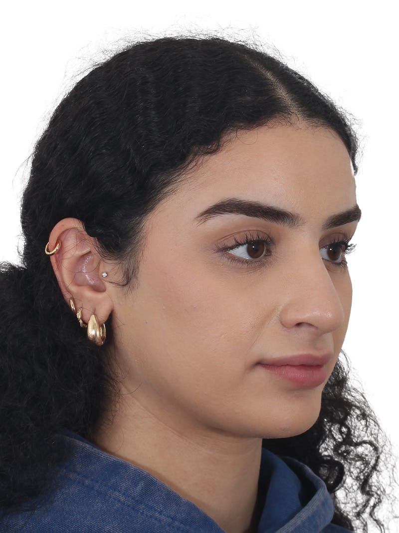 Rhinoplasty Before & After Gallery - Patient 324042 - Image 4