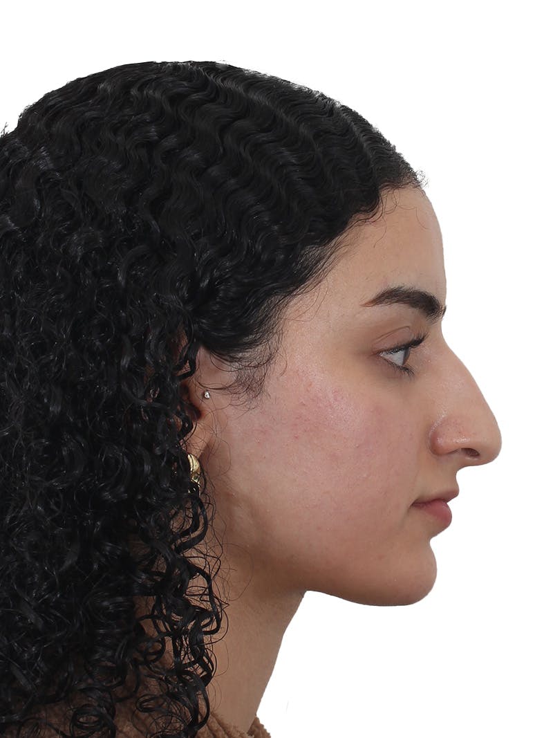 Rhinoplasty Before & After Gallery - Patient 324042 - Image 1