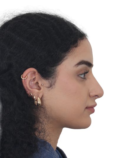 Rhinoplasty Before & After Gallery - Patient 324042 - Image 2
