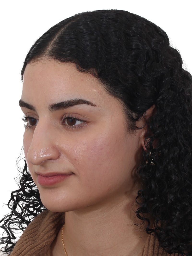 Rhinoplasty Before & After Gallery - Patient 324042 - Image 7