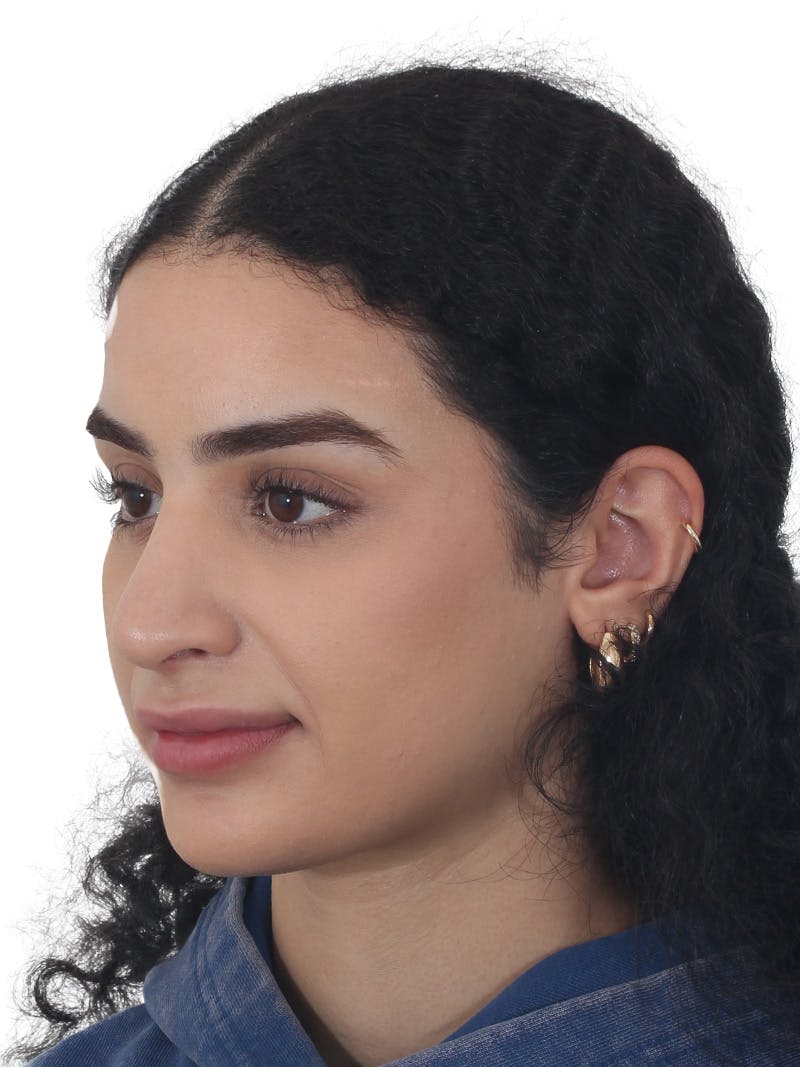 Rhinoplasty Before & After Gallery - Patient 324042 - Image 8