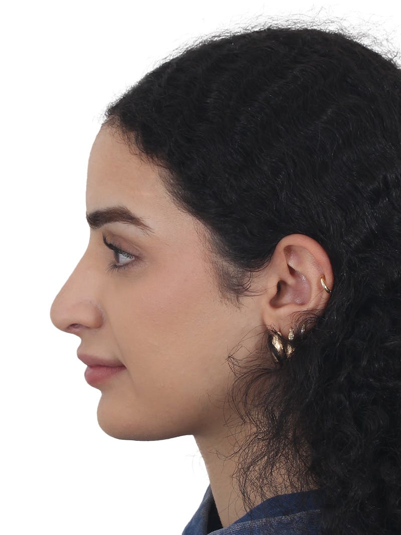 Rhinoplasty Before & After Gallery - Patient 324042 - Image 10