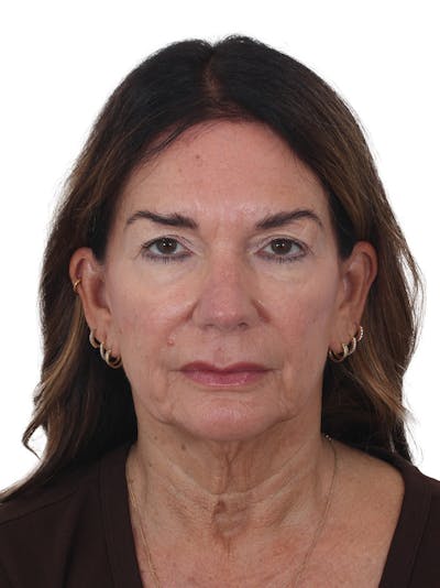 Laser Treatment Before & After Gallery - Patient 438281 - Image 1