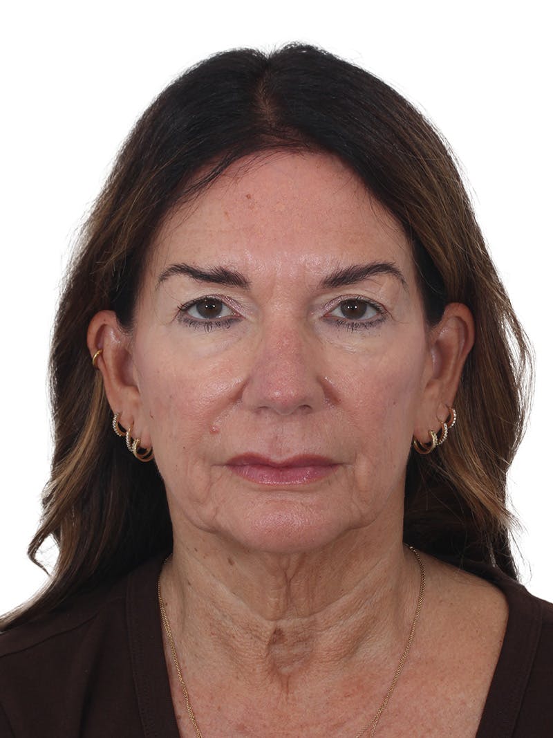Laser Treatment Before & After Gallery - Patient 438281 - Image 1