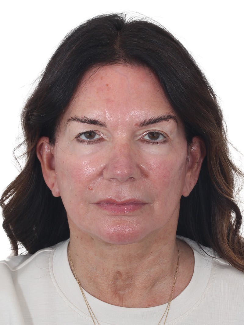 Laser Treatment Before & After Gallery - Patient 438281 - Image 2