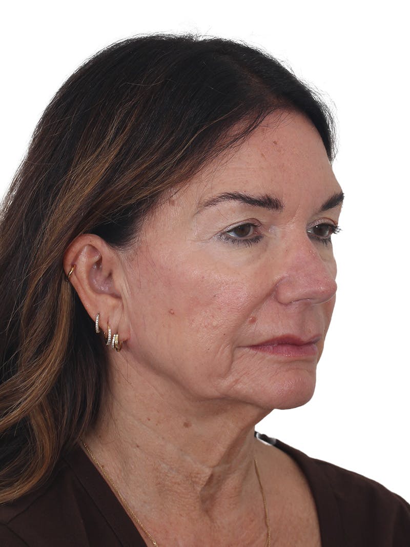 Laser Treatment Before & After Gallery - Patient 438281 - Image 3