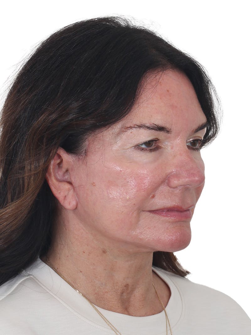 Laser Treatment Before & After Gallery - Patient 438281 - Image 4