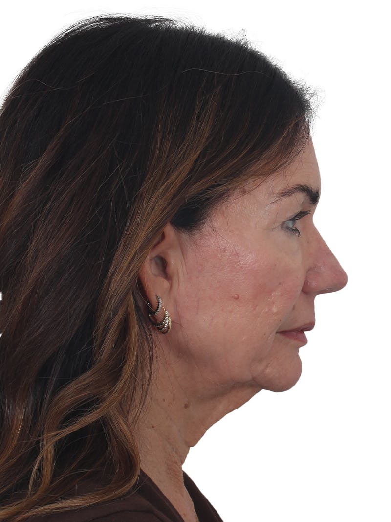 Laser Treatment Before & After Gallery - Patient 438281 - Image 5