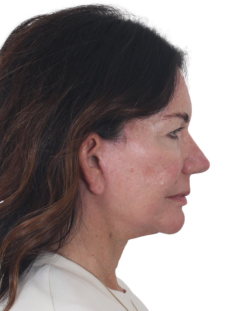 Laser Treatment Before & After Gallery - Patient 438281 - Image 6