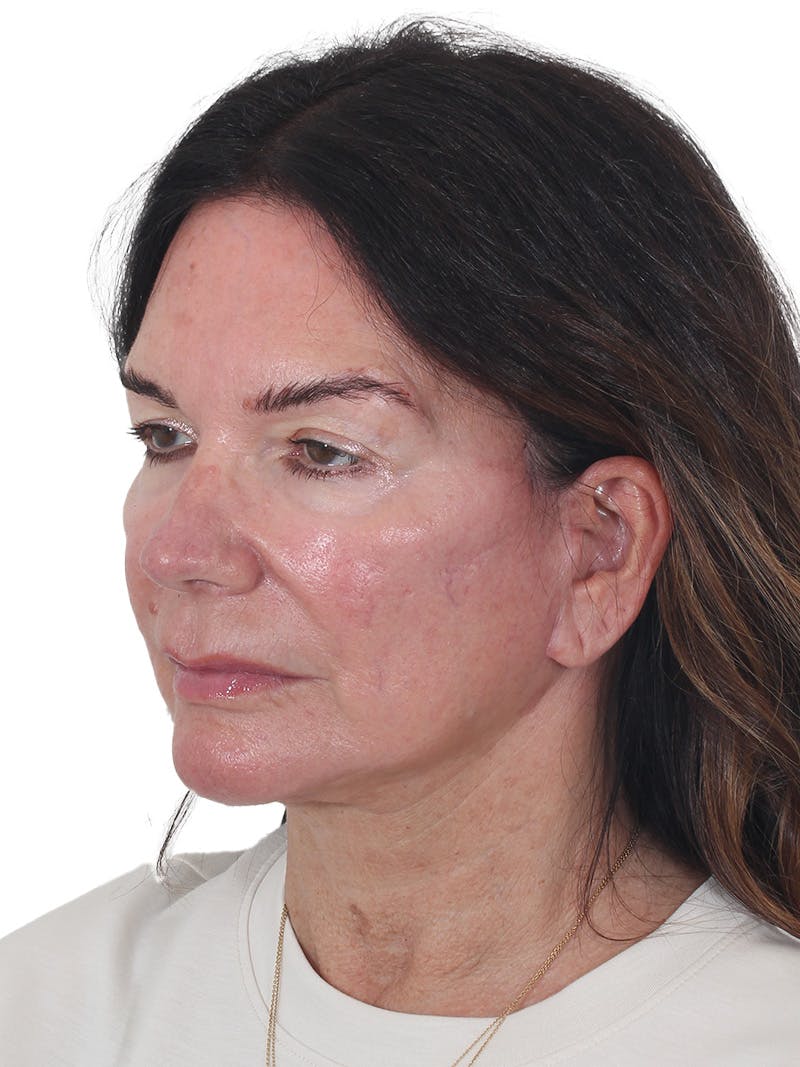 Laser Treatment Before & After Gallery - Patient 438281 - Image 8