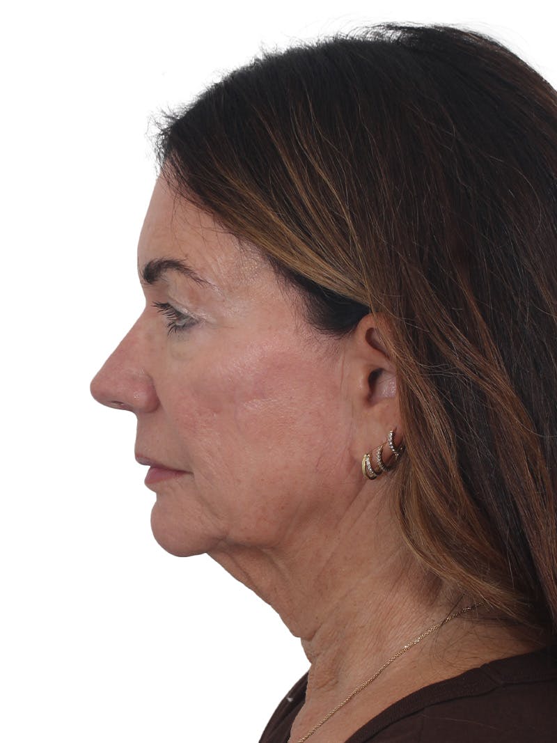 Laser Treatment Before & After Gallery - Patient 438281 - Image 9