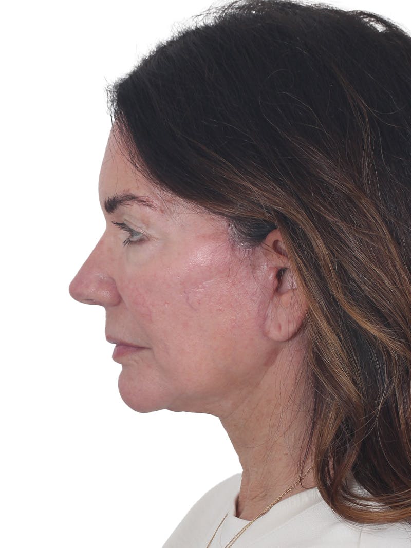 Laser Treatment Before & After Gallery - Patient 438281 - Image 10