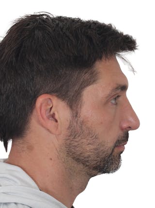 Rhinoplasty Before & After Gallery - Patient 380859 - Image 2