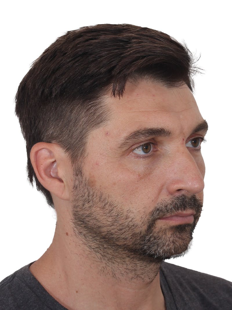 Rhinoplasty Before & After Gallery - Patient 380859 - Image 3