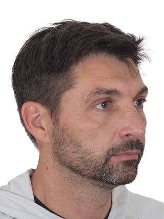 Rhinoplasty Before & After Gallery - Patient 380859 - Image 4