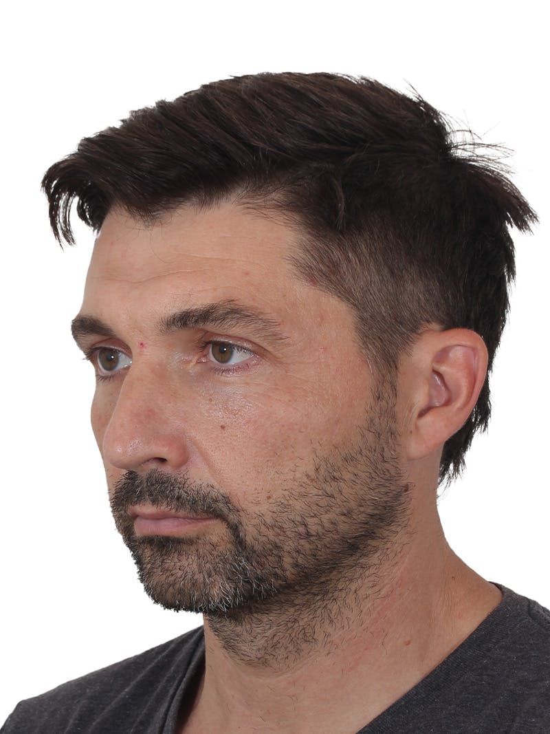 Rhinoplasty Before & After Gallery - Patient 380859 - Image 5