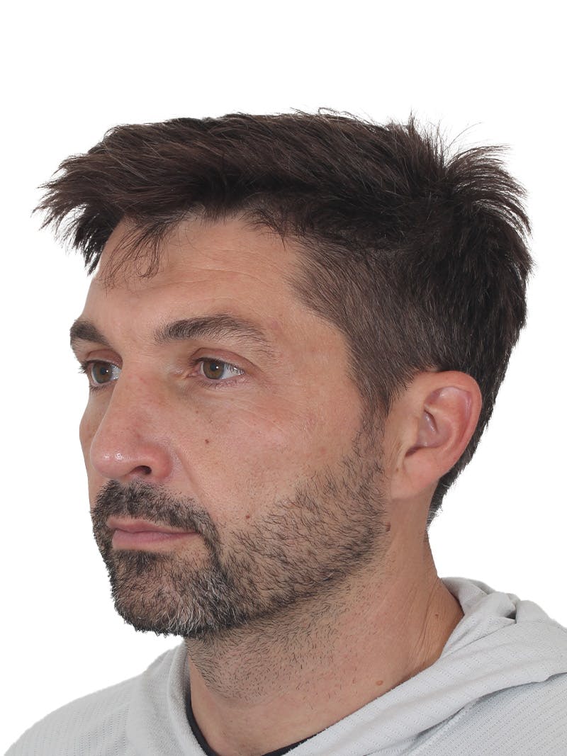Rhinoplasty Before & After Gallery - Patient 380859 - Image 6