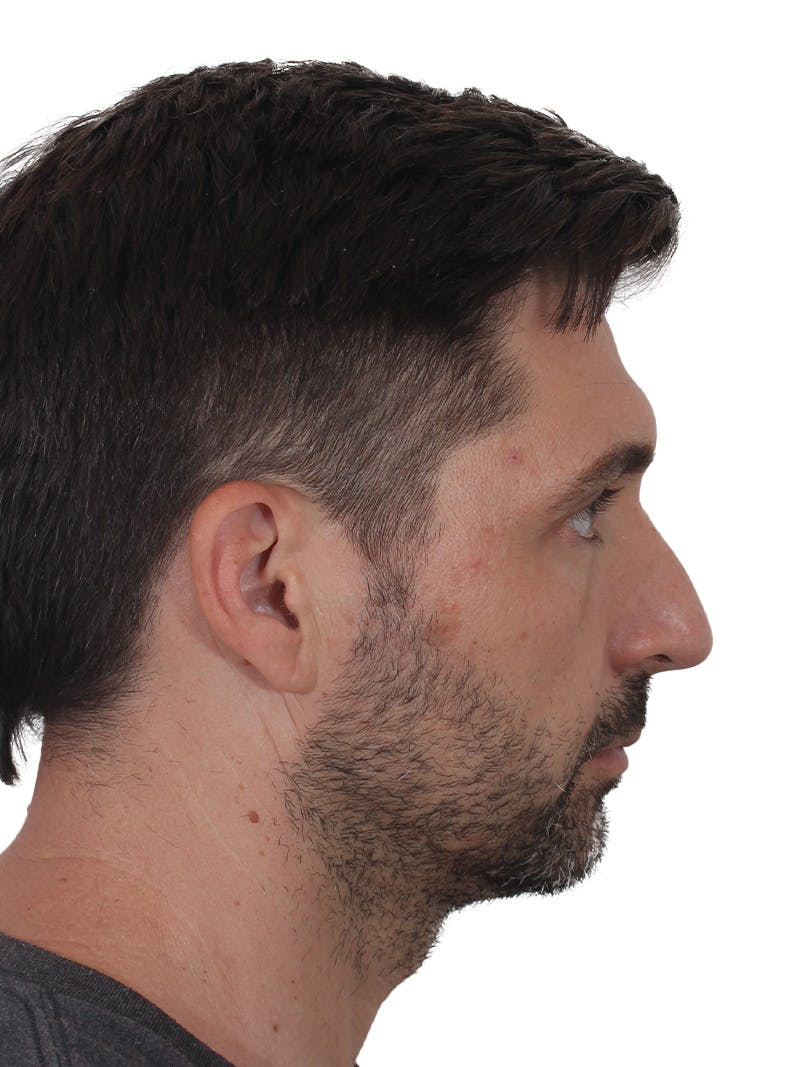 Rhinoplasty Before & After Gallery - Patient 380859 - Image 1