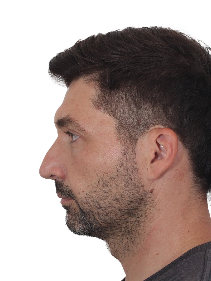 Rhinoplasty Before & After Gallery - Patient 380859 - Image 7