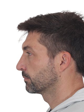 Rhinoplasty Before & After Gallery - Patient 380859 - Image 8