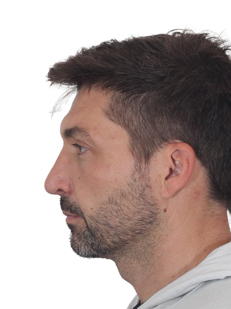Rhinoplasty Before & After Gallery - Patient 380859 - Image 8