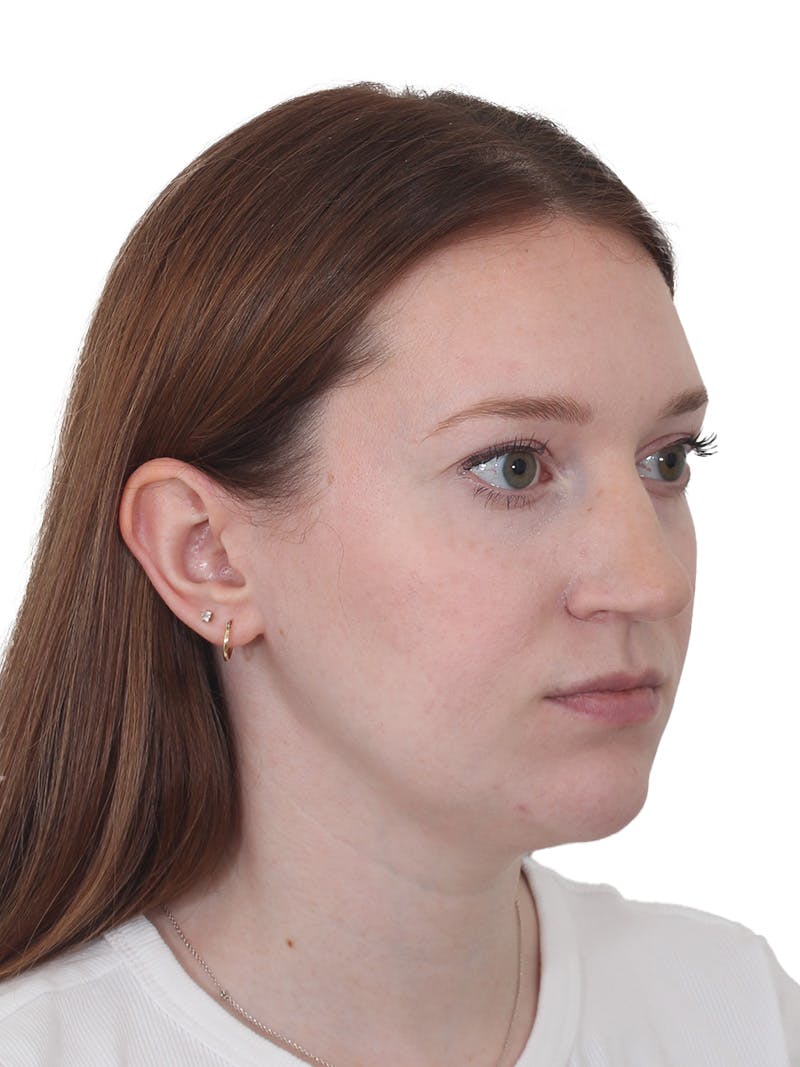 Chin Augmentation Before & After Gallery - Patient 295998 - Image 3