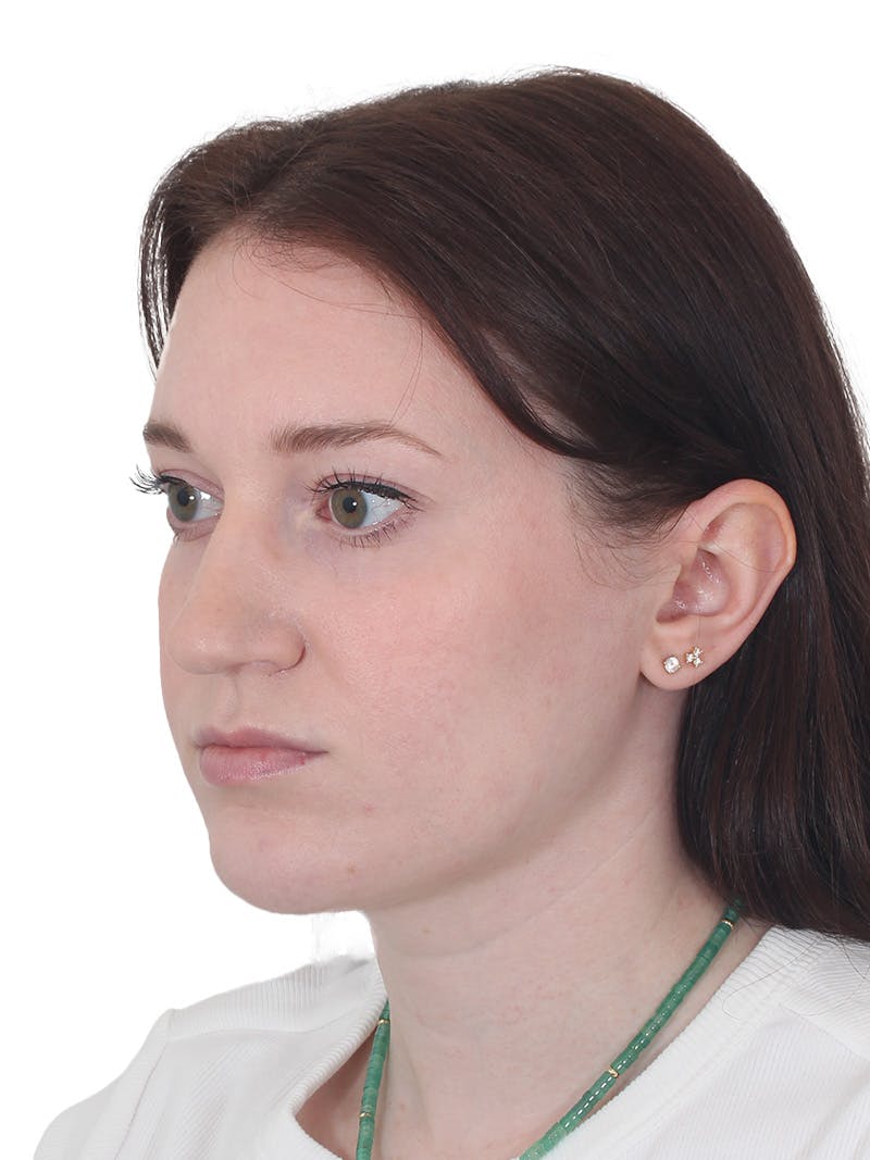 Chin Augmentation Before & After Gallery - Patient 295998 - Image 6