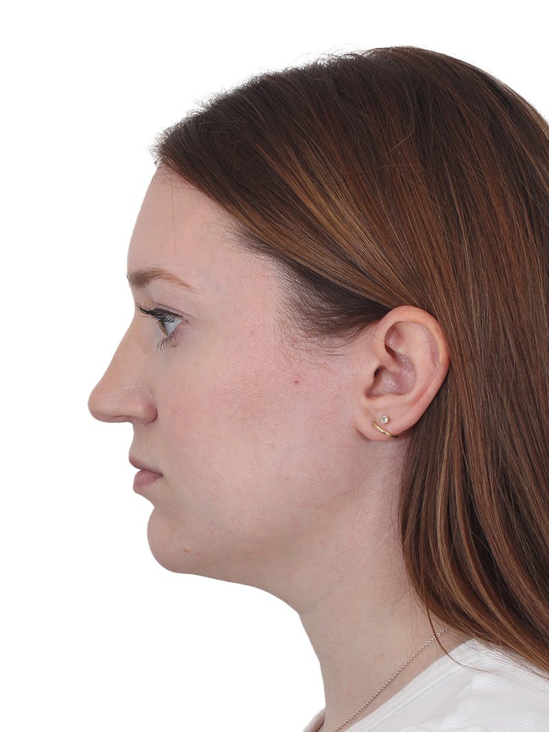 Chin Augmentation Before & After Gallery - Patient 295998 - Image 7