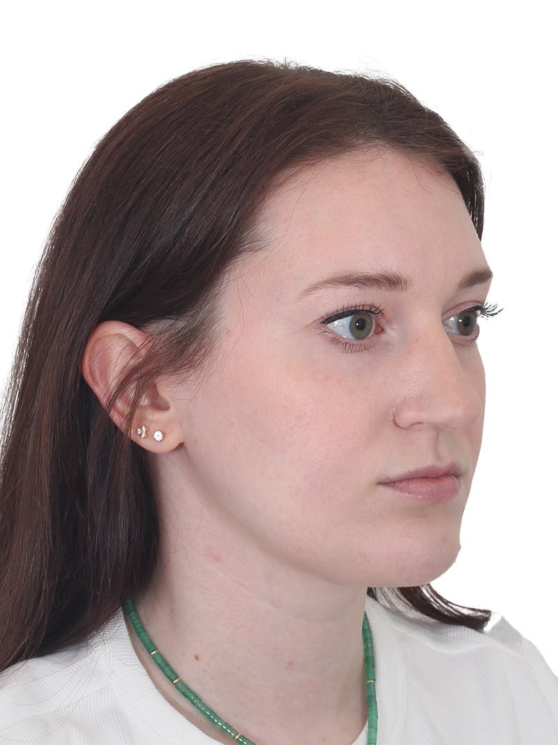 Chin Augmentation Before & After Gallery - Patient 295998 - Image 4