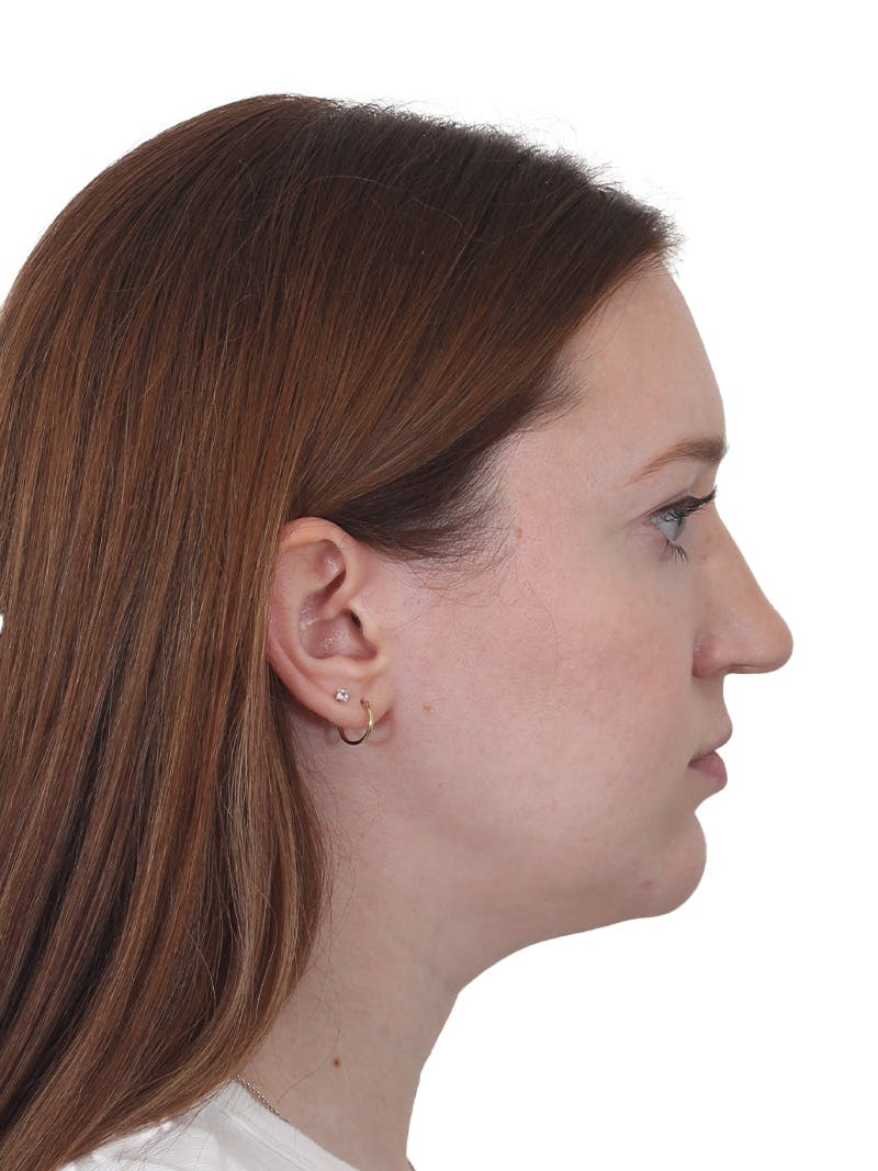 Chin Augmentation Before & After Gallery - Patient 295998 - Image 1