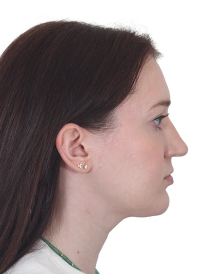 Chin Augmentation Before & After Gallery - Patient 295998 - Image 2