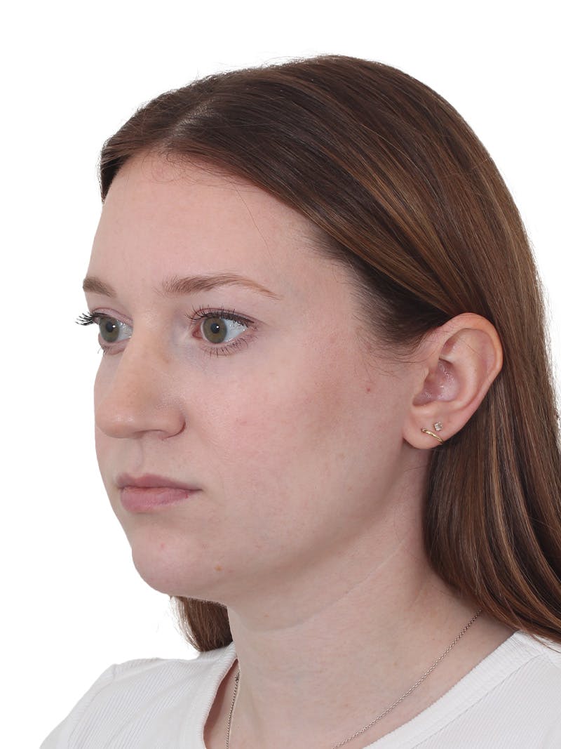 Chin Augmentation Before & After Gallery - Patient 295998 - Image 5