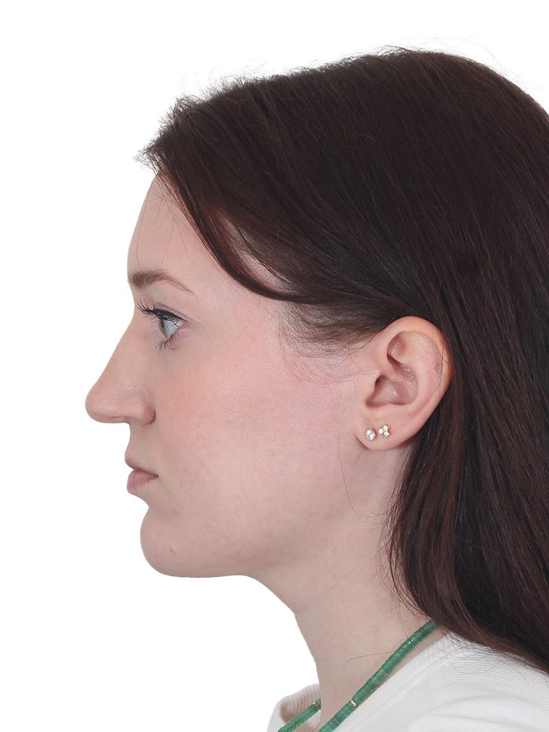 Chin Augmentation Before & After Gallery - Patient 295998 - Image 8