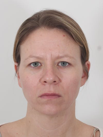 Brow Lift Before & After Gallery - Patient 234004 - Image 1