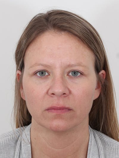 Blepharoplasty Before & After Gallery - Patient 155211 - Image 2