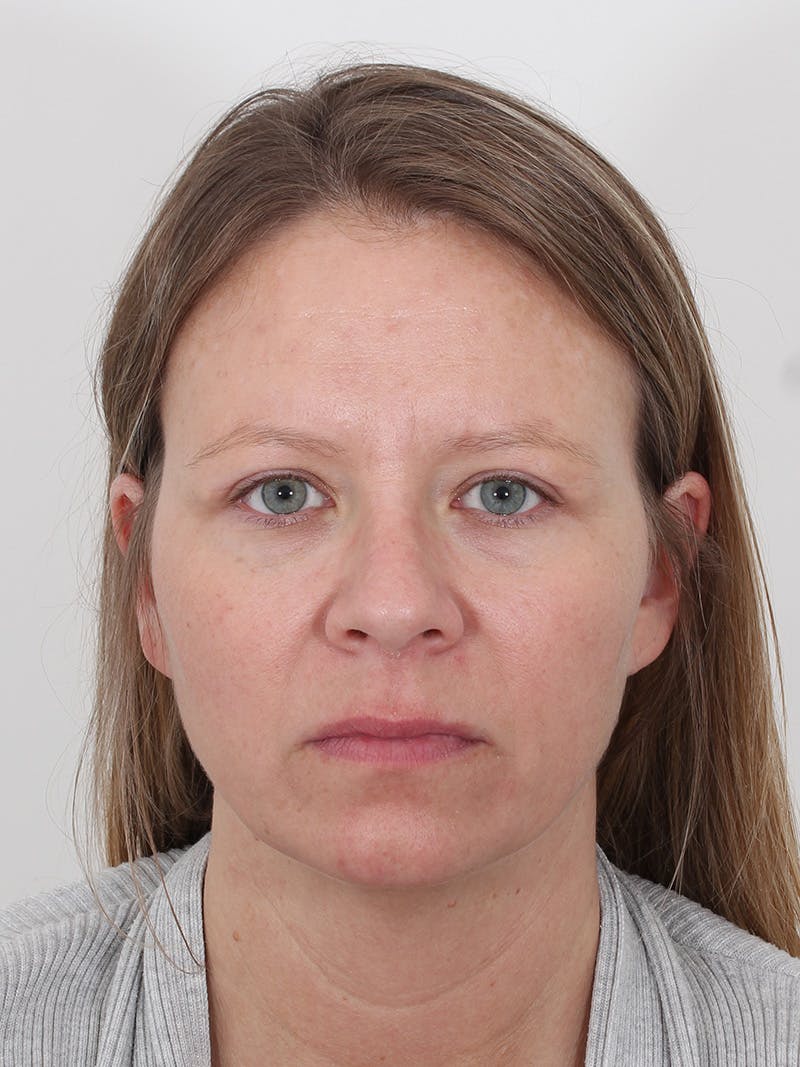 Brow Lift Before & After Gallery - Patient 234004 - Image 2