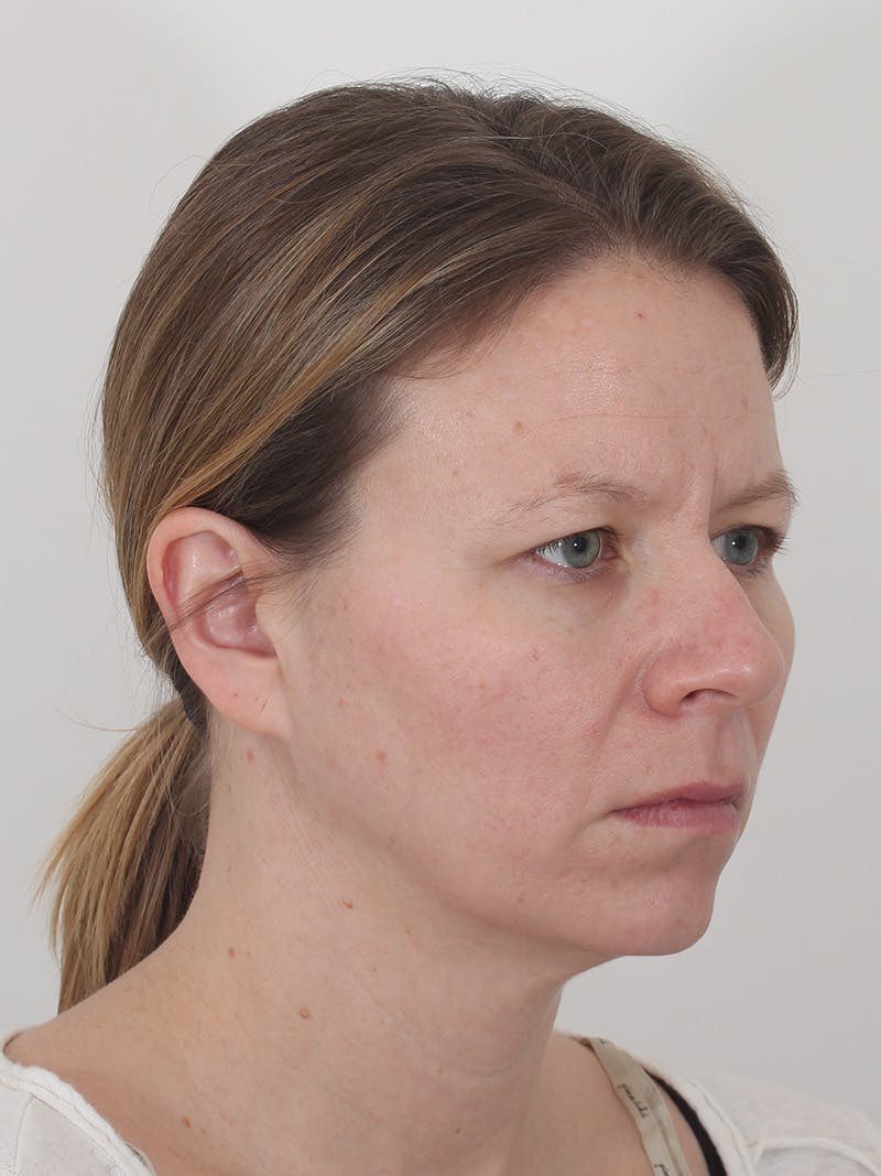 Brow Lift Before & After Gallery - Patient 234004 - Image 3