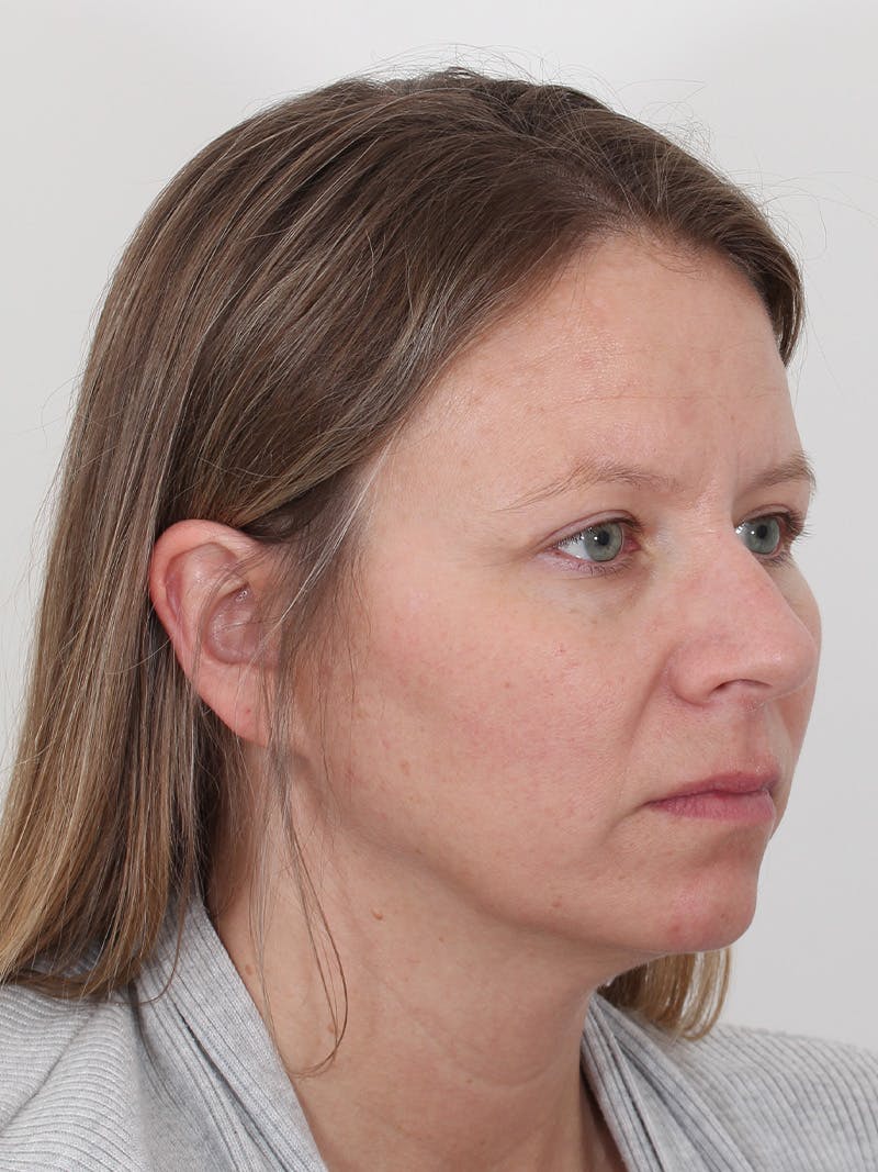 Brow Lift Before & After Gallery - Patient 234004 - Image 4