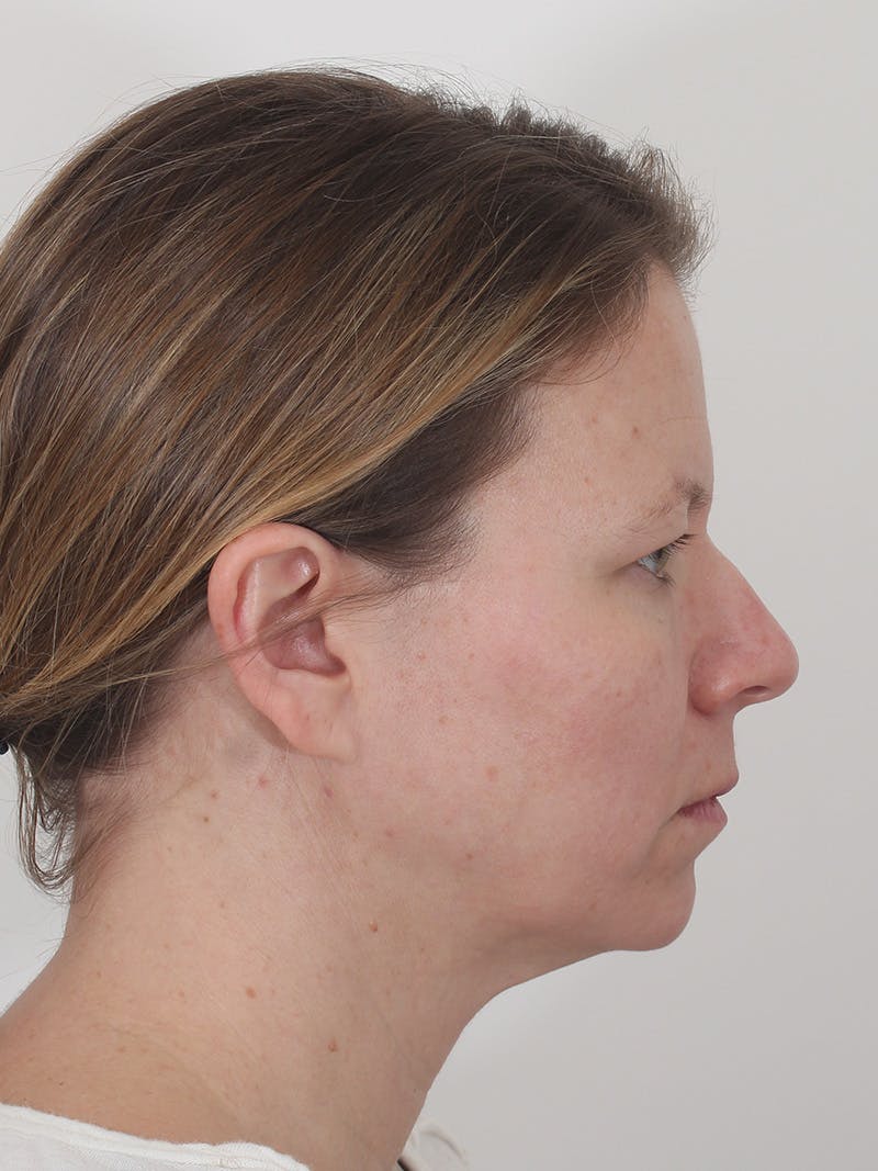 Brow Lift Before & After Gallery - Patient 234004 - Image 5