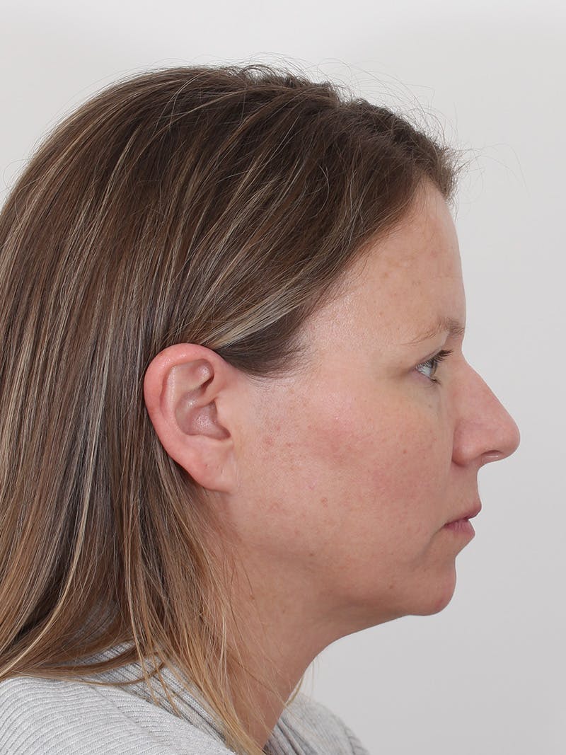 Brow Lift Before & After Gallery - Patient 234004 - Image 6