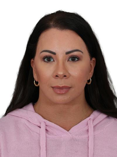 Brow Lift Before & After Gallery - Patient 325025 - Image 2
