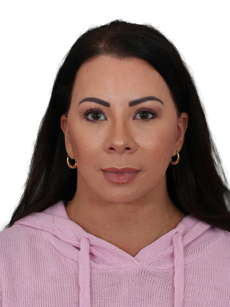 Blepharoplasty Before & After Gallery - Patient 392015 - Image 2