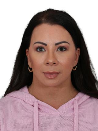 Brow Lift Before & After Gallery - Patient 325025 - Image 2